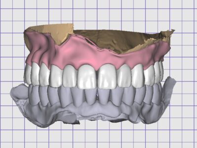 Prótese digital/CAD